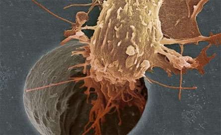 سلول سرطاني