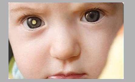 برق زدن چشم کودک نشانه سرطان است