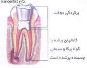 مراحل عصب کشی دندان(با تصاویر)