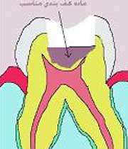 مراحل پُر کردن دندان(با تصاویر)