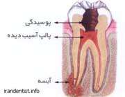 مراحل عصب کشی دندان(با تصاویر)