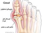 انگشتان پا در نقرس