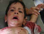 enfant irakien blessé 