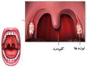 گلودرد و لوزه ها