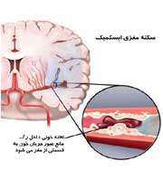 سکته مغزي
