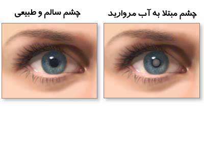 عوارض - علت - درمان : آب مروارید یا کاتاراکت