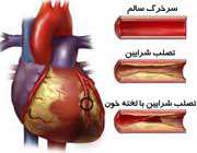 تصلب شرایین در قلب