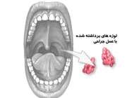 در آوردن لوزه ها