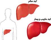کبد سالم و کبد بیمار