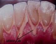 جرم دندان