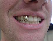  دندان طلا