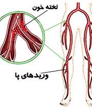 لخته خون در وریدهای پا