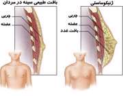 بزرگ شدن بافت سینه در مردان