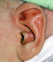 ear infections symptom in baby