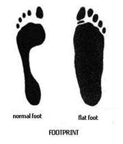 flatfeet