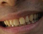 زرد شدن دندان ها