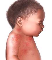التهابات پوستي در کودک
