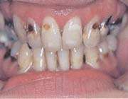 dental problems caused by drug addiction