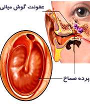 عفونت گوش میانی