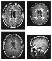 mri with multiple sclerosis 
