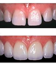 درمان فاصله بین دو دندان