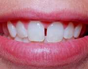 فاصله بین دو دندان