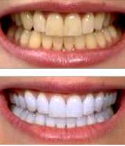 دندان  زرد و دندان سفید