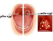 التهاب لوزه