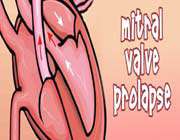 mitral valve prolapse 