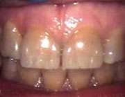 دندان خاکستری رنگ