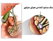 سنگ کيسه صفرا