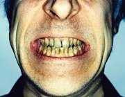 دندان های زرد فرد سیگاری