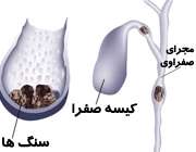 سنگ کیسه صفرا