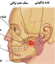 سنگ غدد بزاقی