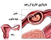 بارداری خلرج از رحم