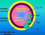 bladder-tumour-stages
