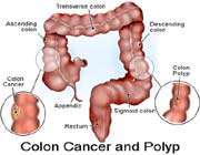 colon cancer