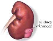 kidney cancer 