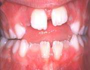 a 9 year old patient with open bite caused by (thumb sucking habit).
