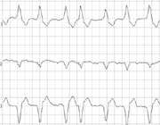 atrial fibrillation runs in families