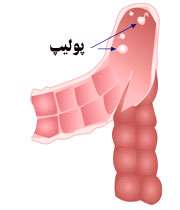 پوليپ