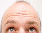 baldness