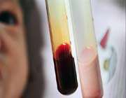 فقر الدم شائع بين الصغار