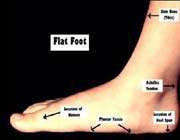 flat foot