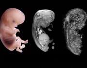 سونوگرافی جنین در بارداری