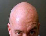 baldness