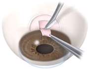 درمان آب سیاه چشم با عمل جراحی