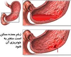 زخم و خونریزی معده