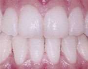 سفیدکردن دندان
