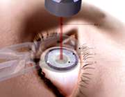 درمان آب سیاه چشم با جراحی لیزر